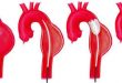 Aortic Stent Grafts Market