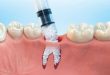 Dental Bone Graft Substitutes And Other Biomaterials Market