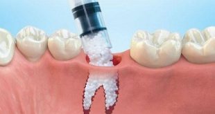 Dental Bone Graft Substitutes And Other Biomaterials Market