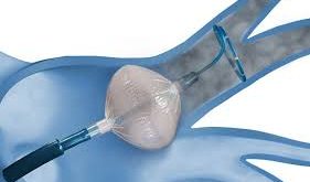 Cryoablation Devices Market