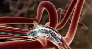 Intracranial Stents Market