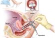 Cervical Dysplasia Diagnostic Market