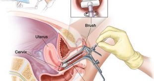 Cervical Dysplasia Diagnostic Market