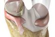 Collagen Meniscus Implant Market