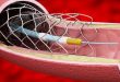 Interventional Cardiology And Peripheral Vascular Devices Market