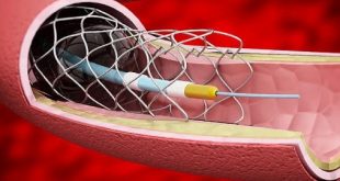 Interventional Cardiology And Peripheral Vascular Devices Market