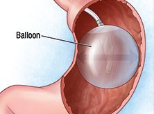 Intragastric Balloons Market