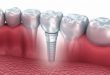 Osseointegration Implants Market